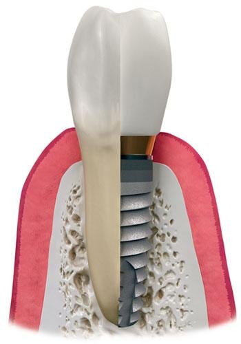 This is a graphic of dental implants, which are small titanium posts that are surgically placed into the jawbone where teeth are missing.