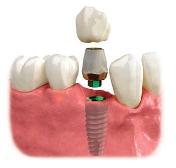 This is a graphic showing dental implant metal anchors which act as tooth root substitutes. The bone bonds with the titanium, creating a strong foundation for artificial teeth.